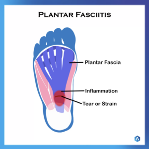 Plantar Fasciitis
